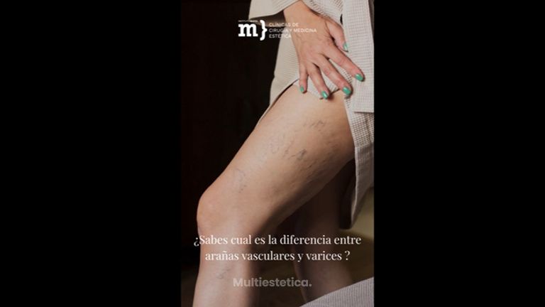 Diferencia entre arañas vasculares y varices - Instituto Marsil