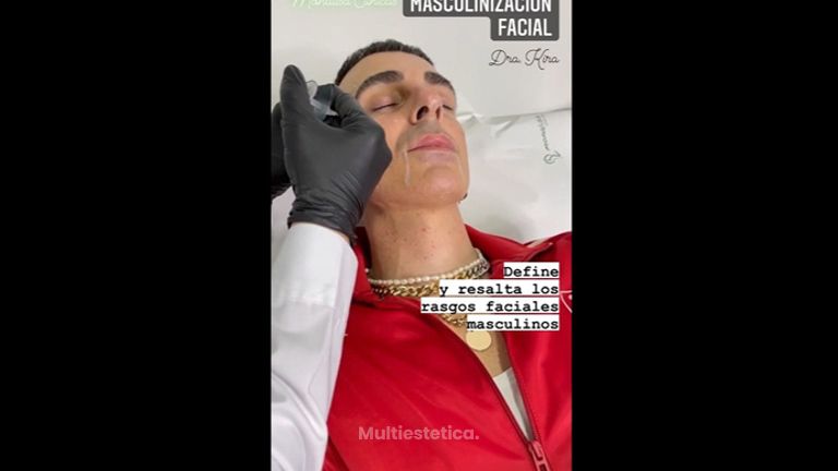 Masculinización facial - Monalisa Clínicas