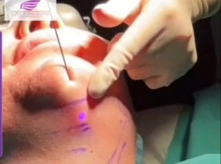 Tratamiento laser de papada