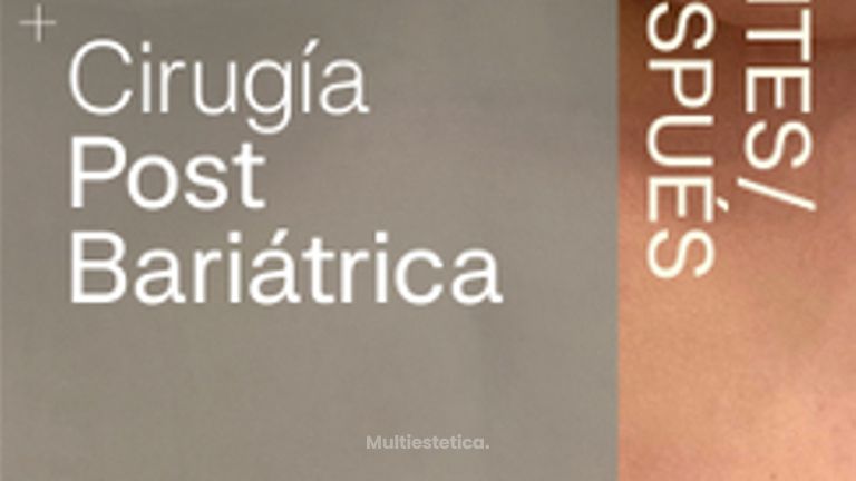 Resultados de cirugía postbariátrica