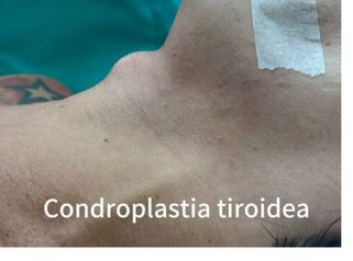 La condroplastia tiroidea o reducción de la nuez de Adán