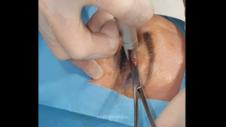 Blefaroplastia - Doctora Barba Martínez