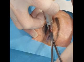 Blefaroplastia - Doctora Barba Martínez