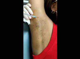 Hidrolipoclasia - Clínica Cabeceran
