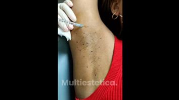 Hidrolipoclasia - Clínica Cabeceran