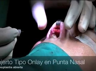 Rinoplastia injerto punta nasal