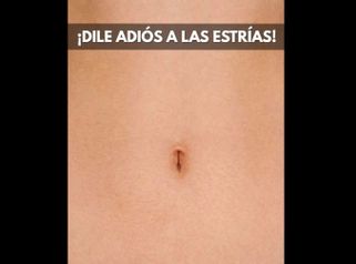 Eliminación de estrías - Imebelle