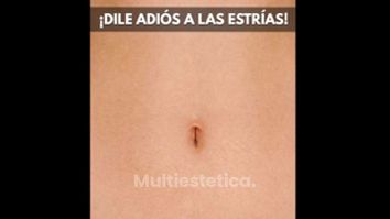 Eliminación de estrías - Imebelle