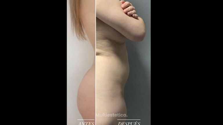 Resultados de Liposucciones - Clínica Leben & Körper