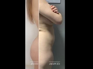 Resultados de Liposucciones - Clínica Leben & Körper