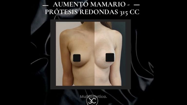 Aumento de pecho - Dr. Jose Casarrubios