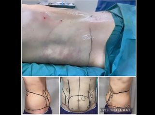 Abdominoplastia - Dr. Felipe Galiano Uribe