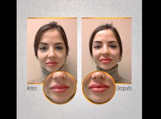 Aumento de labios - Dr. Daniel Colomer