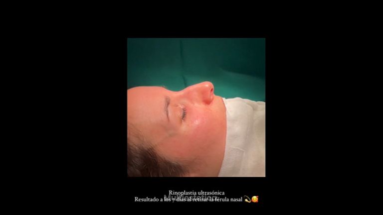 Rinoplastia - Dr. Pérez Villar