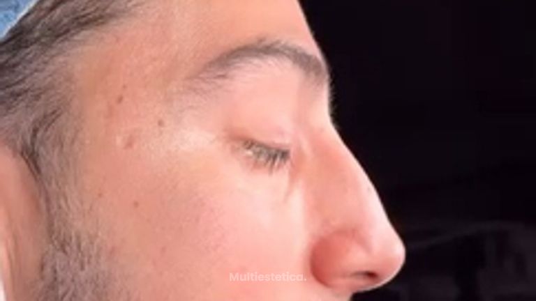 Antes y después inmediato y resultado a los 7 días de su cirugía de rinoplastia ultrasónica