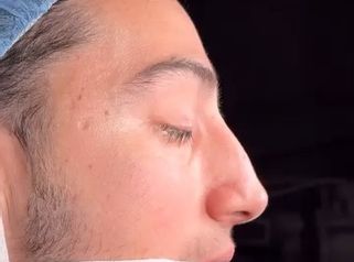 Antes y después inmediato y resultado a los 7 días de su cirugía de rinoplastia ultrasónica