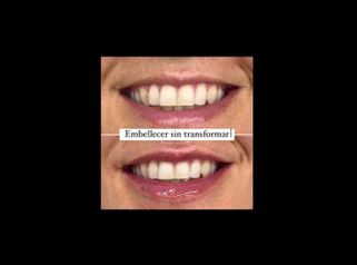 Aumento labios - Clínica Dr. Carvajal