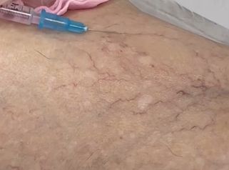 Clínica Carlos Gómez - Arañas vasculares