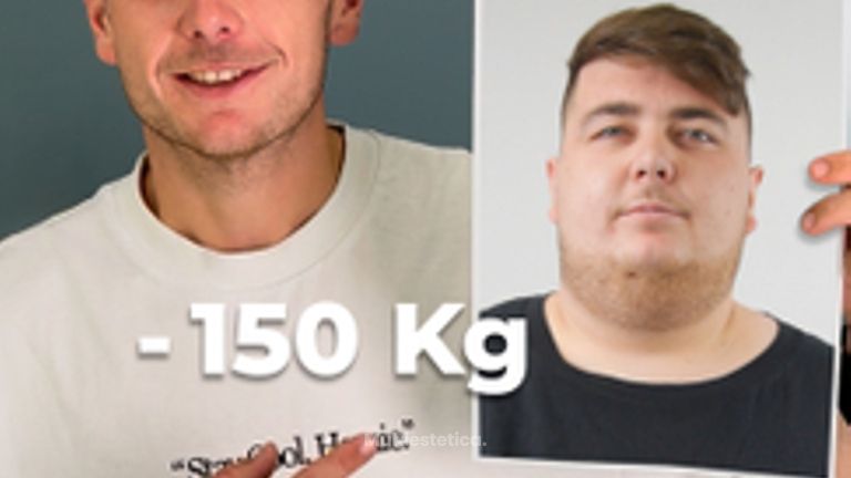 -150 kg con Cirugía Bariátrica