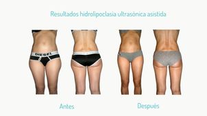 Hidroplipoclasia 1 Hidroplipoclasia 1