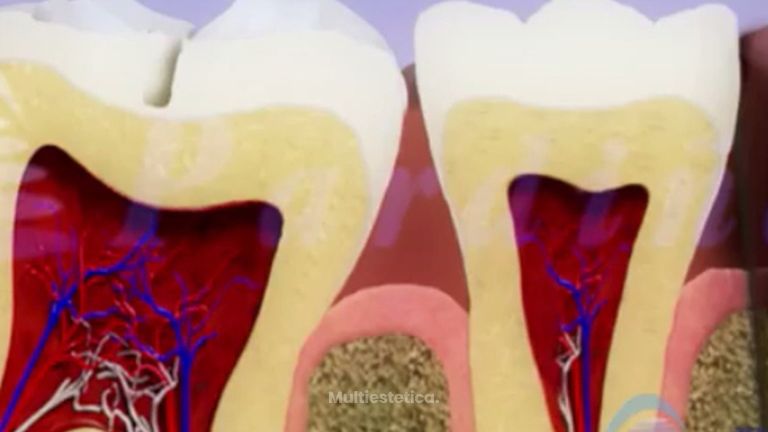 Acaba con las caries dentales