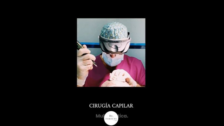 Trasplante Capilar - Dr. Josep Antoni Fortuny Cid
