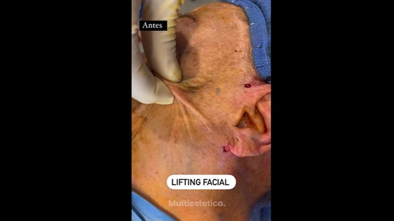 Lifting facial - Clínica Dr. Jiménez