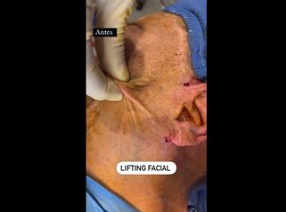 Lifting facial - Clínica Dr. Jiménez