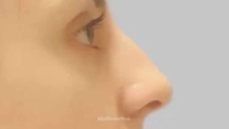 Rinoplastia