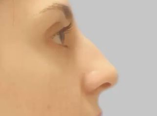 Rinoplastia