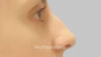 Rinoplastia