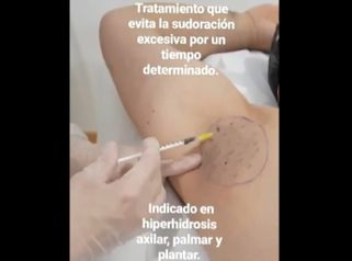 Clínica Dra. Any Ramírez - Hiperhidrosis