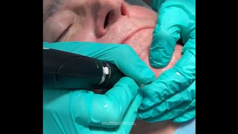 HydraFacial - Humildad Ruiz
