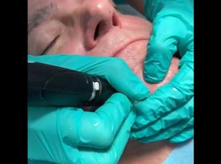 HydraFacial - Humildad Ruiz
