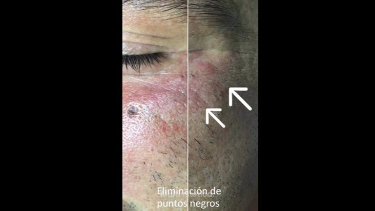 Tratamiento antiacné - Dr. Juan Enrique Pérez Enríquez