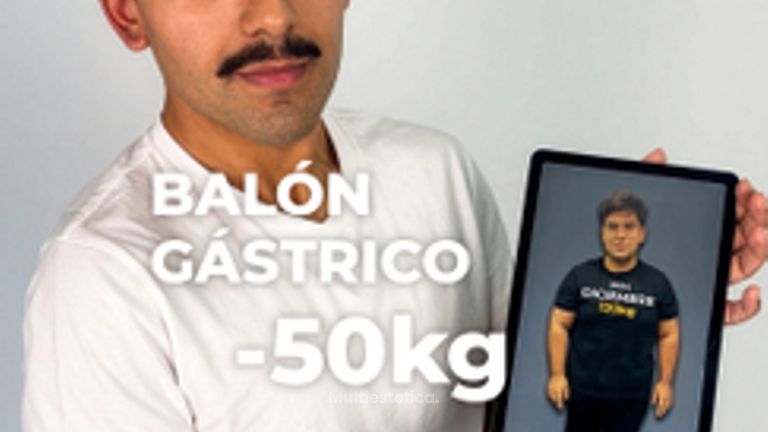 -50 kg en 1 año con Balón Gástrico - Clínica Opción Médica