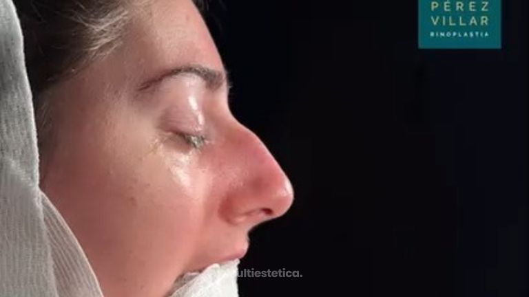 Resultado antes y después inmediato