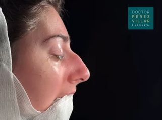 Resultado antes y después inmediato