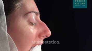 Resultado antes y después inmediato