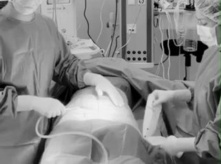 Abdominoplastia