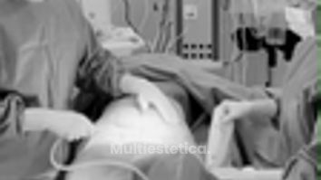 Abdominoplastia