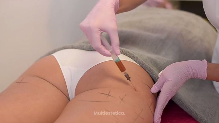 ¿Cuáles son los tratamientos de remodelación corporal?