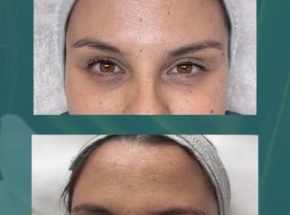 Rellenos faciales - Hakari Clinics