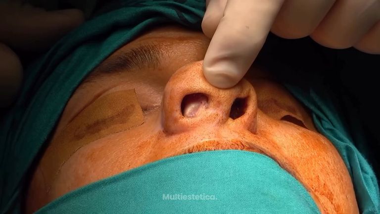 🎥 II Jornadas Quirúrgicas en Rinoplastia Secundaria