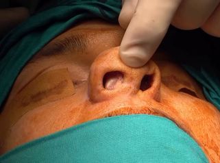 🎥 II Jornadas Quirúrgicas en Rinoplastia Secundaria