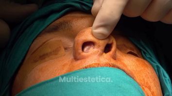 🎥 II Jornadas Quirúrgicas en Rinoplastia Secundaria