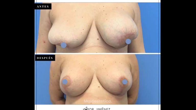 Matopexia - Dr. Jiménez Ortiz