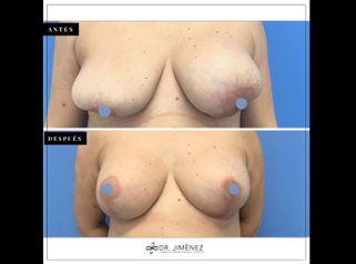 Matopexia - Dr. Jiménez Ortiz