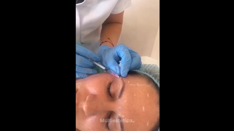 Rellenos faciales - Dra. Denisa Bangean