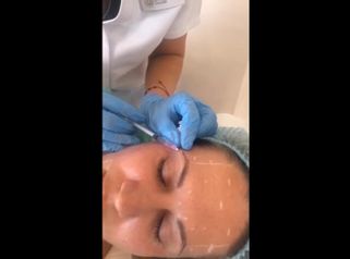 Rellenos faciales - Dra. Denisa Bangean